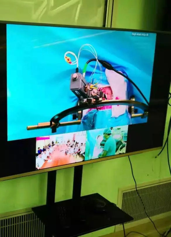 國內首例5G網絡手術